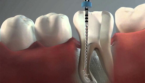 Existe alguna alternativa a la endodoncia