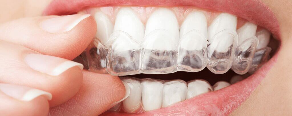 ventajas de la ortodoncia con Invisalign 1 Ventajas de la ortodoncia con Invisalign