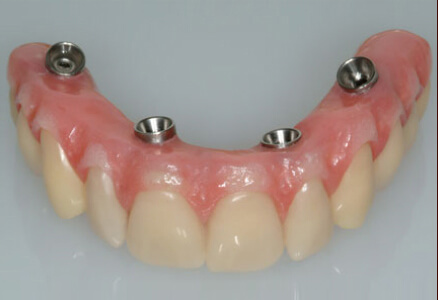 Prótesis Dental en Barcelona 12 All On Four