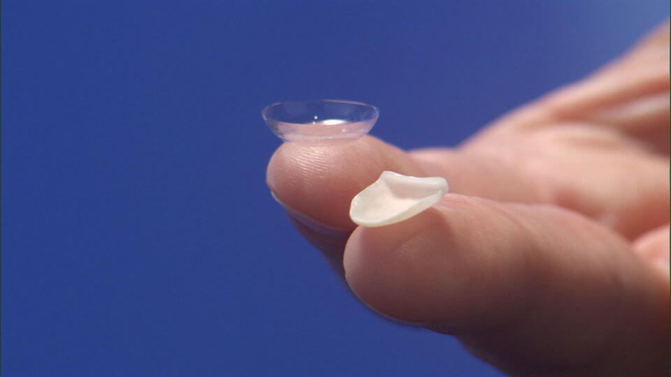 Las carillas Lumineers