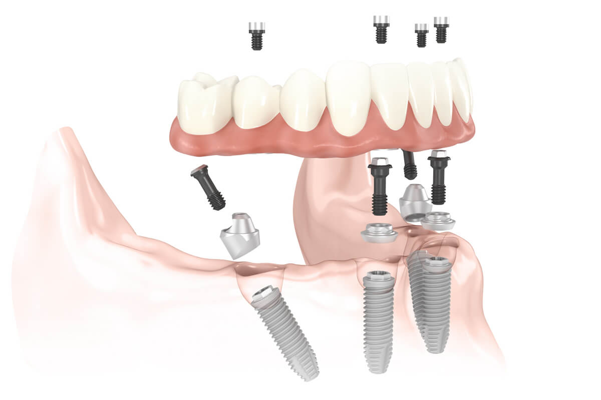 Prótesis fija sobre dientes VS prótesis implantes