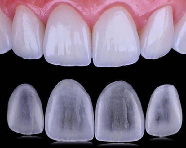 Clinica Dental ME Barcelona - Carillas Dentales