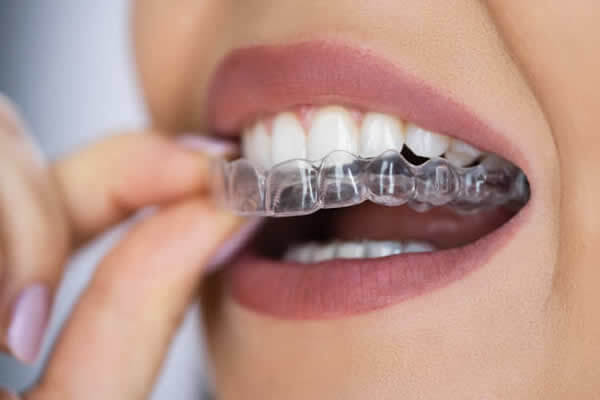Clinica Dental ME Barcelona - Ortodoncia - Fase 2