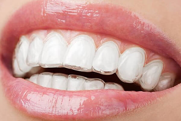 Clinica Dental ME Barcelona - Ortodoncia - Fase 3