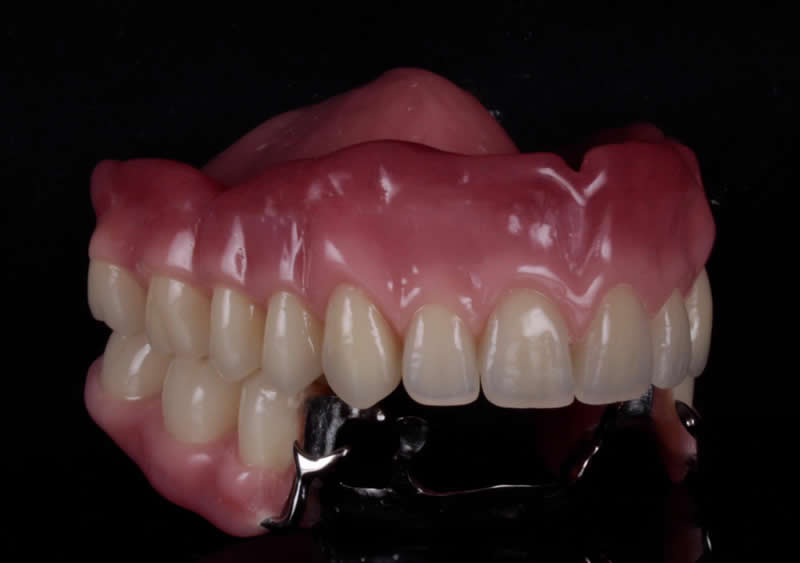 Clinica Dental ME Barcelona - Protesis Parciales
