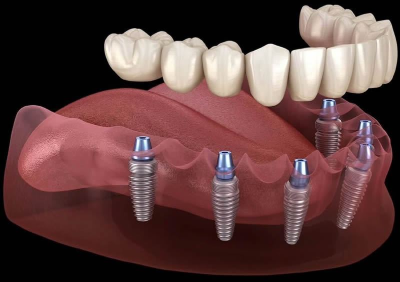 Clinica Dental ME Barcelona - Protesis sobre implantes