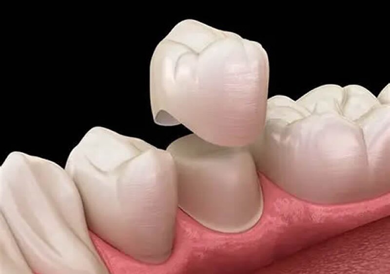 Clinica Dental ME Barcelona - Protesis Dentales