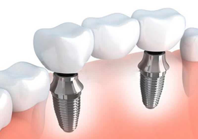Clinica Dental ME Barcelona - Protesis Parcial Implantosoportada
