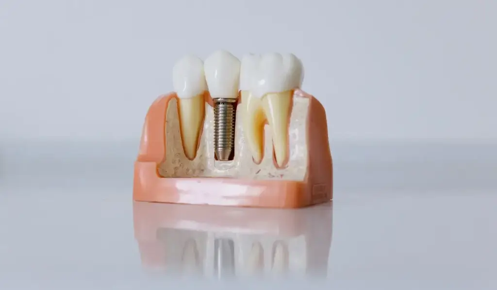 Implantes all on four Barcelona Clinica Mireia Espinosa