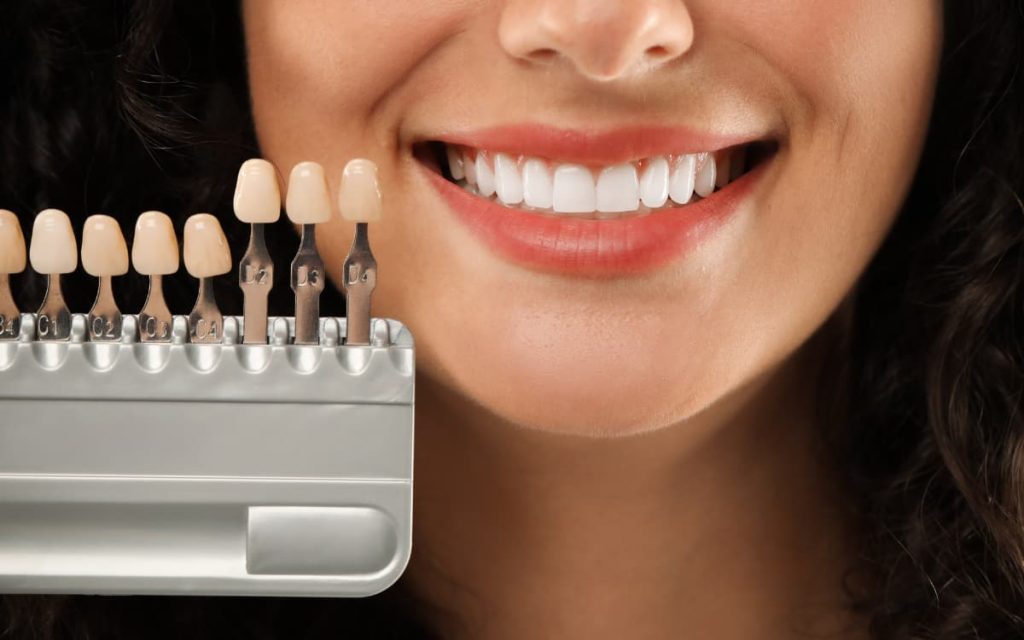 La opción más estable para un cambio visible y sutil 2 Carillas dentales en Barcelona