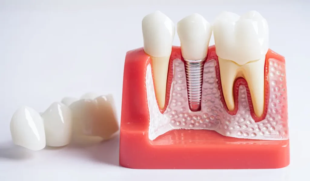 Implantes de carga inmediata en Barcelona