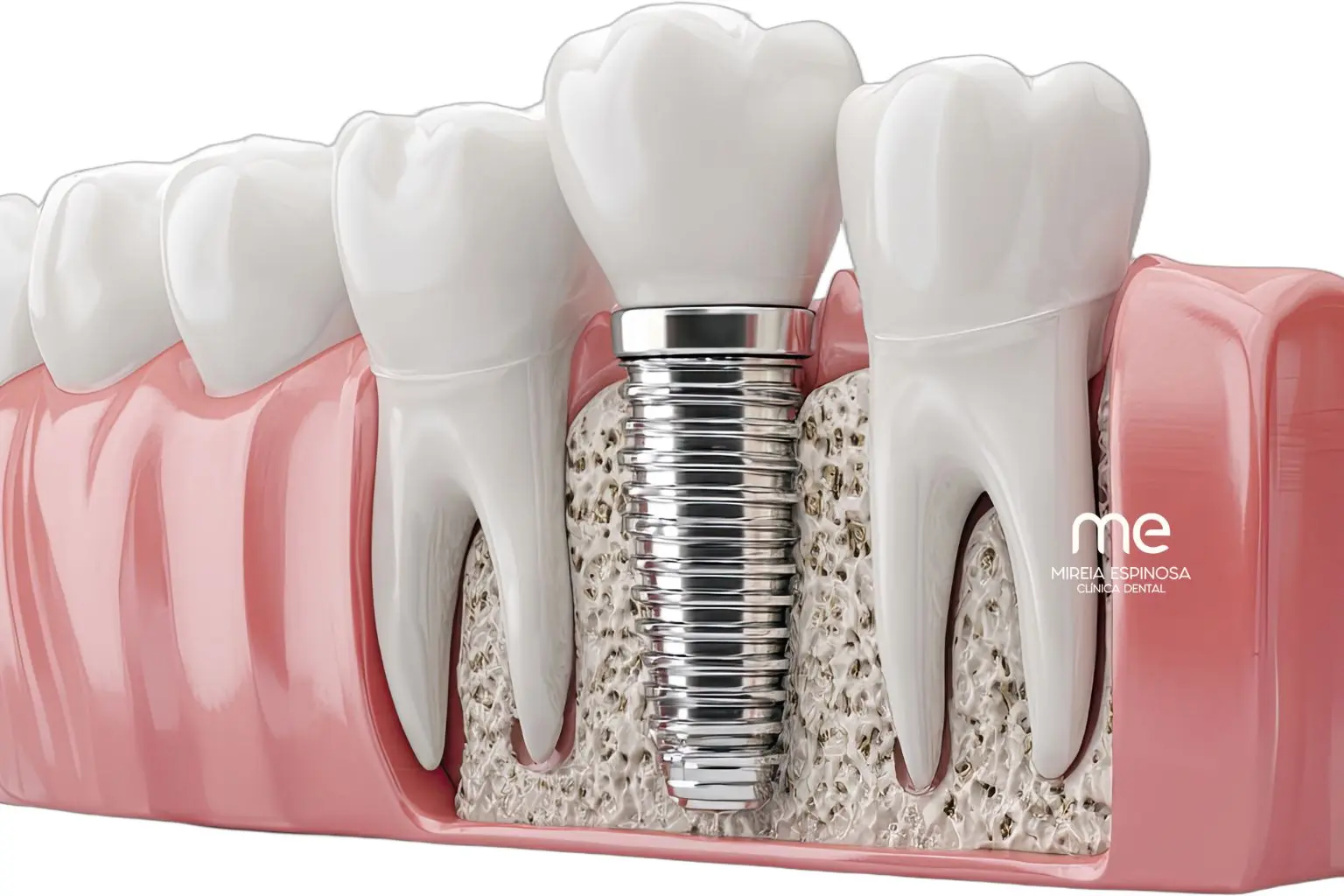 Implantes dentales en Barcelona en Clínica Dental Mireia Espinosa