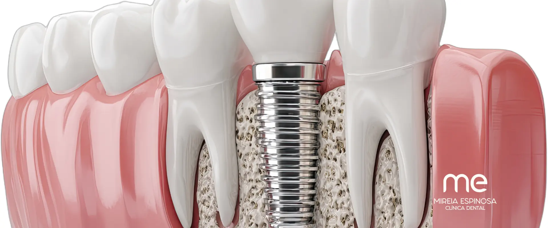 Implantes dentales en Barcelona en Clínica Dental Mireia Espinosa