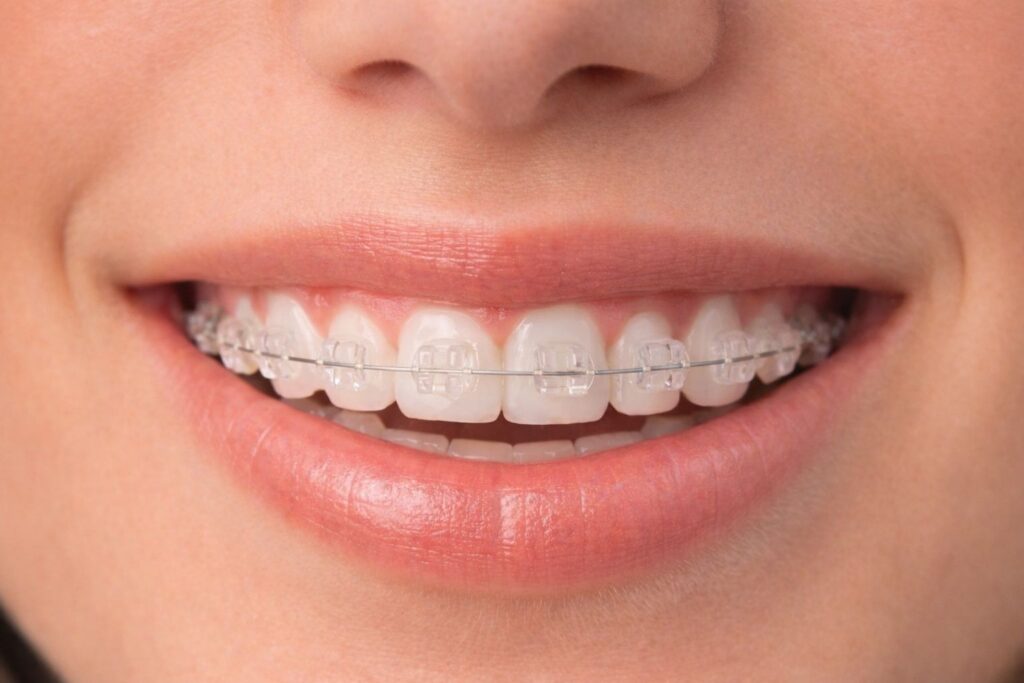 Brackets estéticos en Clinica Mireia Espinosa Barcelona