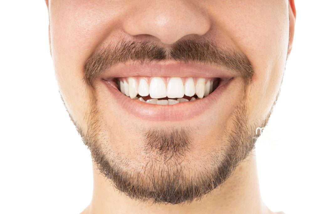 Blanqueamiento Dental Clínica Mireia Espinosa en Barcelona