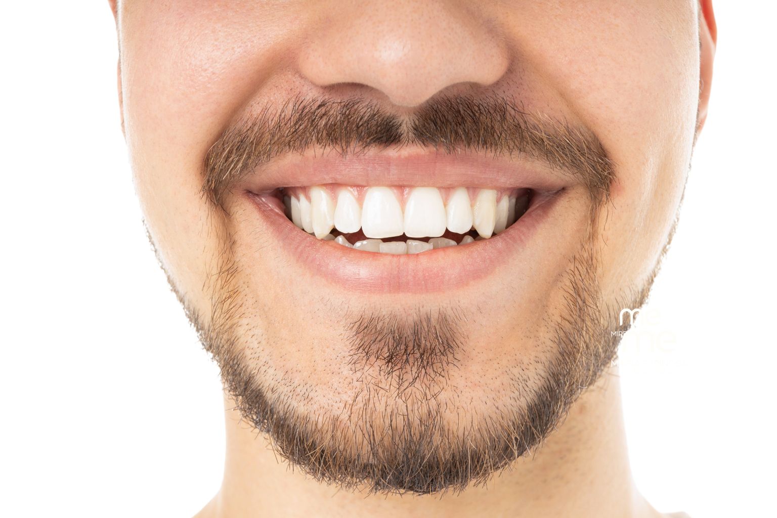Blanqueamiento Dental Clínica Mireia Espinosa en Barcelona