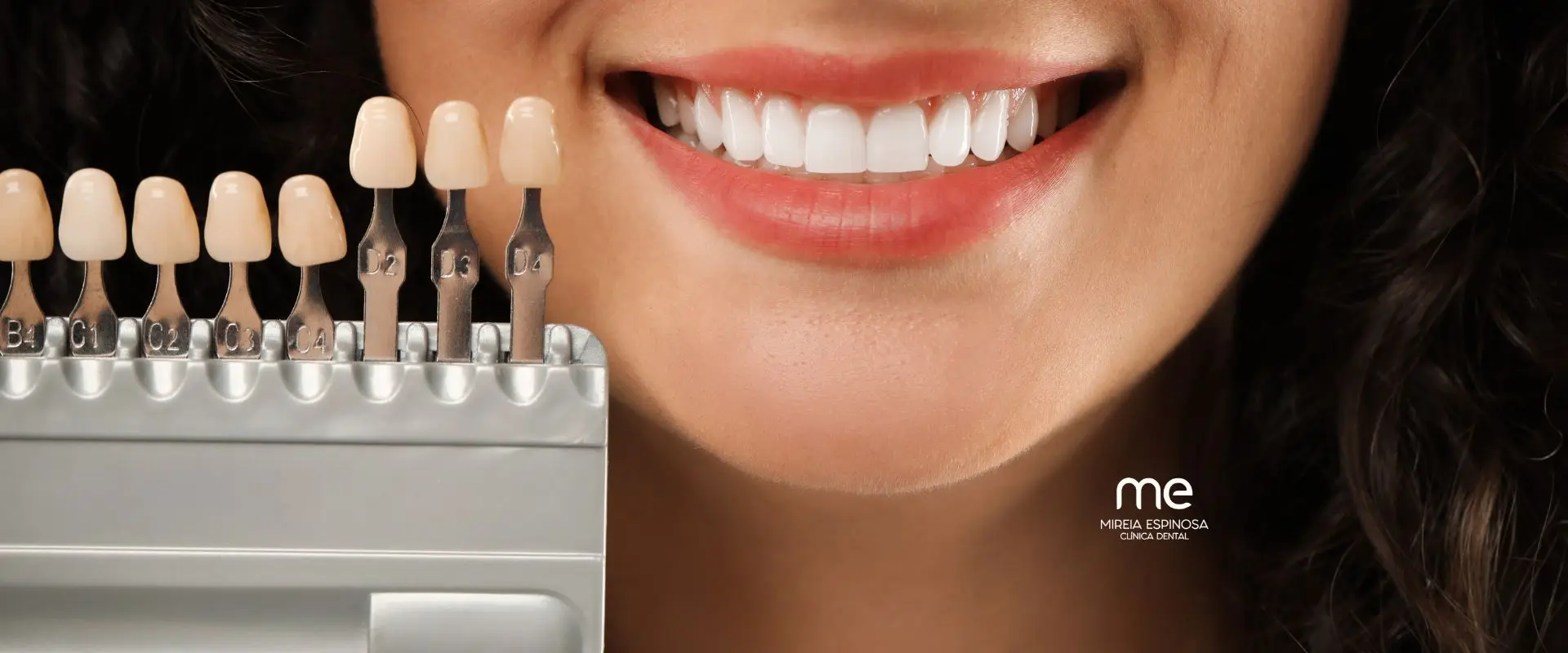 Carillas de porcelana en Clínica Mireia Espinosa