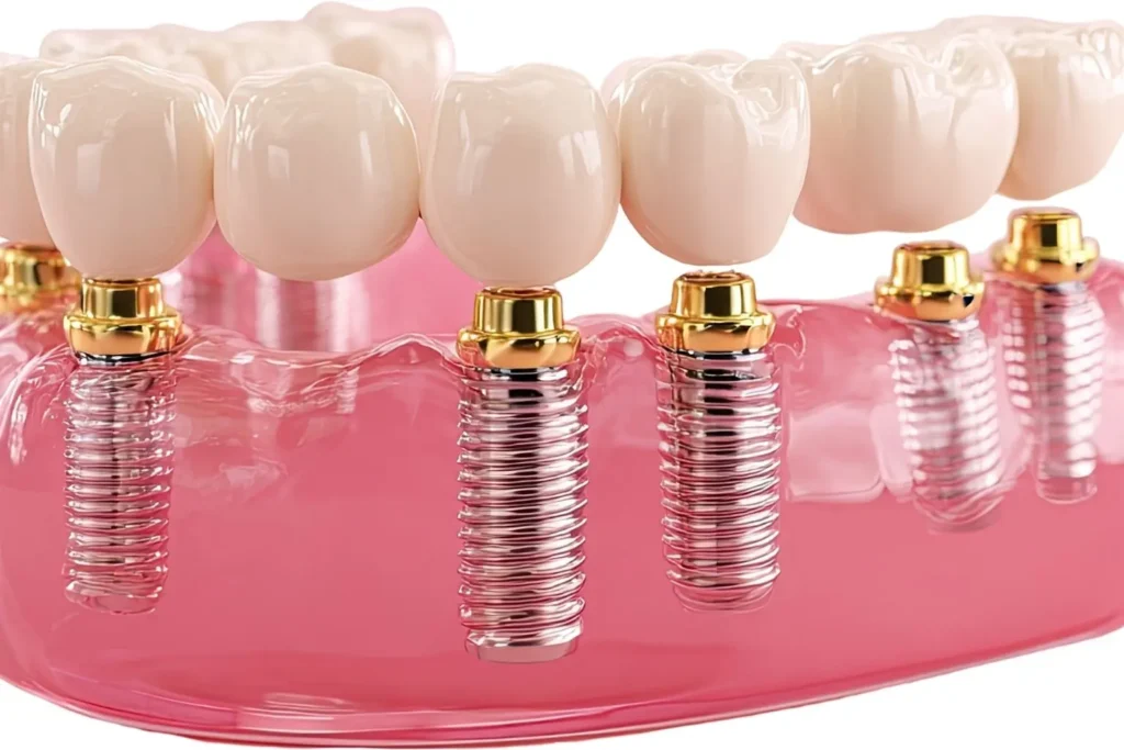 Implantes con carga inmediata múltiple en Clinica Dental Mireia Espinosa