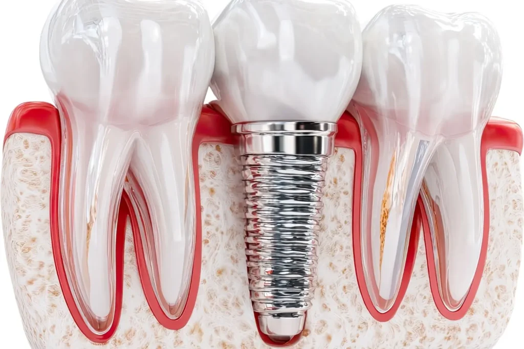 Implantes con carga inmediata unitaria en Clinica Dental Mireia Espinosa