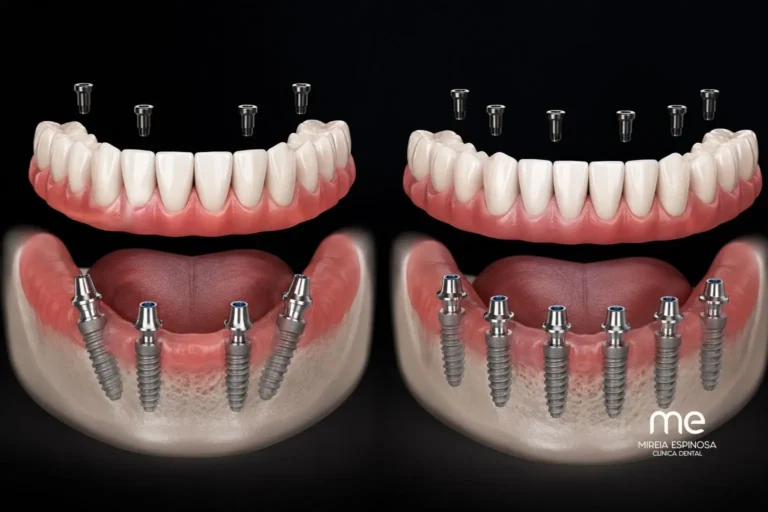 Implantes dentales all on 4 and 6 en Barcelona Clinica Dental Mireia Espinosa