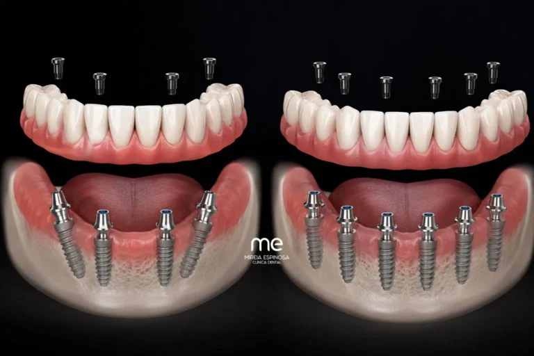 Implantes dentales All on 4 y All on 6 6 Implantes dentales all on 4 and 6 en Barcelona Clinica Dental Mireia Espinosa