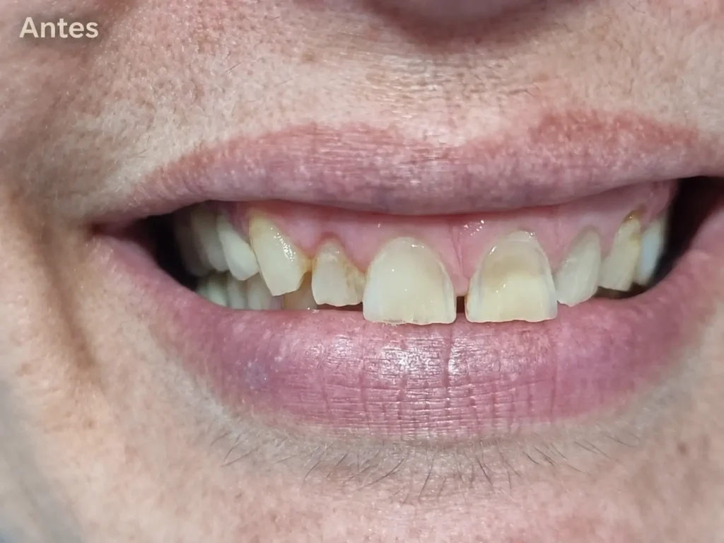 Caso Antes Carillas dentales en CLinica Mireia Espinosa en Eixample Esquerra, (Barcelona)
