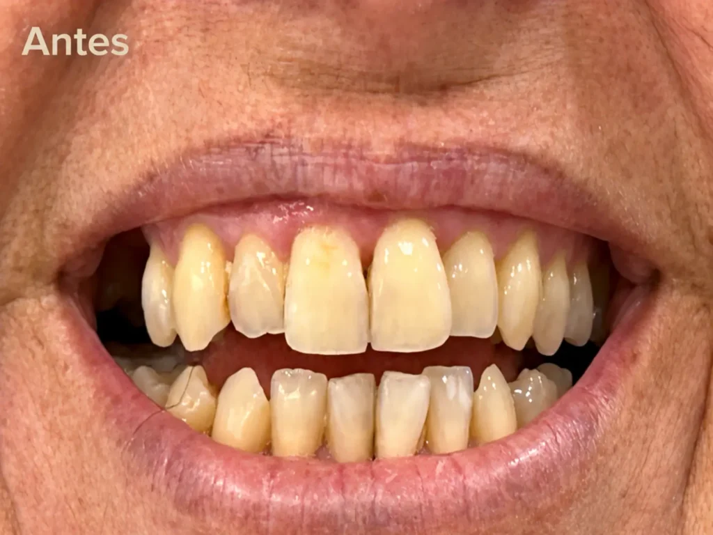 Caso Antes Tratamiento de Blanqueamiento Dental en CLinica Mireia Espinosa en Eixample Esquerra, Barcelona